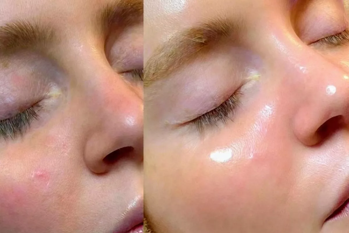 Hydrafacial Bois-Guillaume