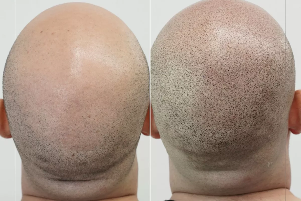 CAPILAIRE OU TRICOPIGMENTATION
