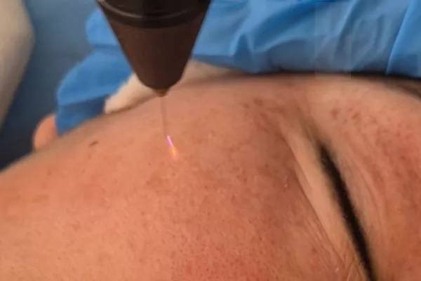 Plasma Froid Shower Visage Éclat