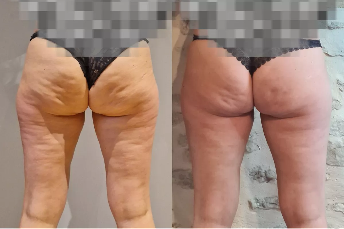 Madérothérapie Corps/zones ciblées