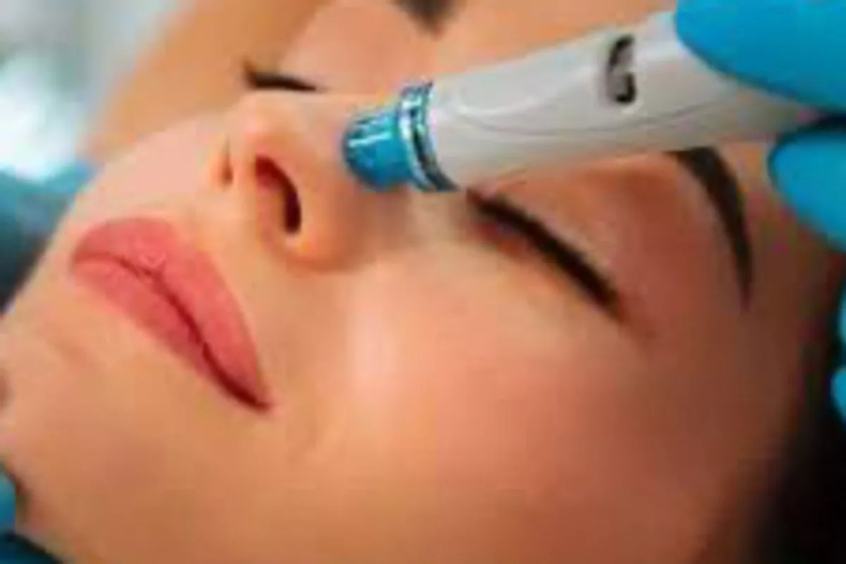 DERMAPLANING