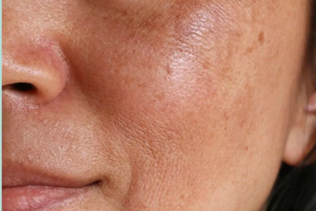 Cure Acné, Taches & Imperfections