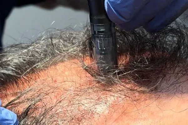 Grande zone : Cuire chevelu complet, ou barbe complètes