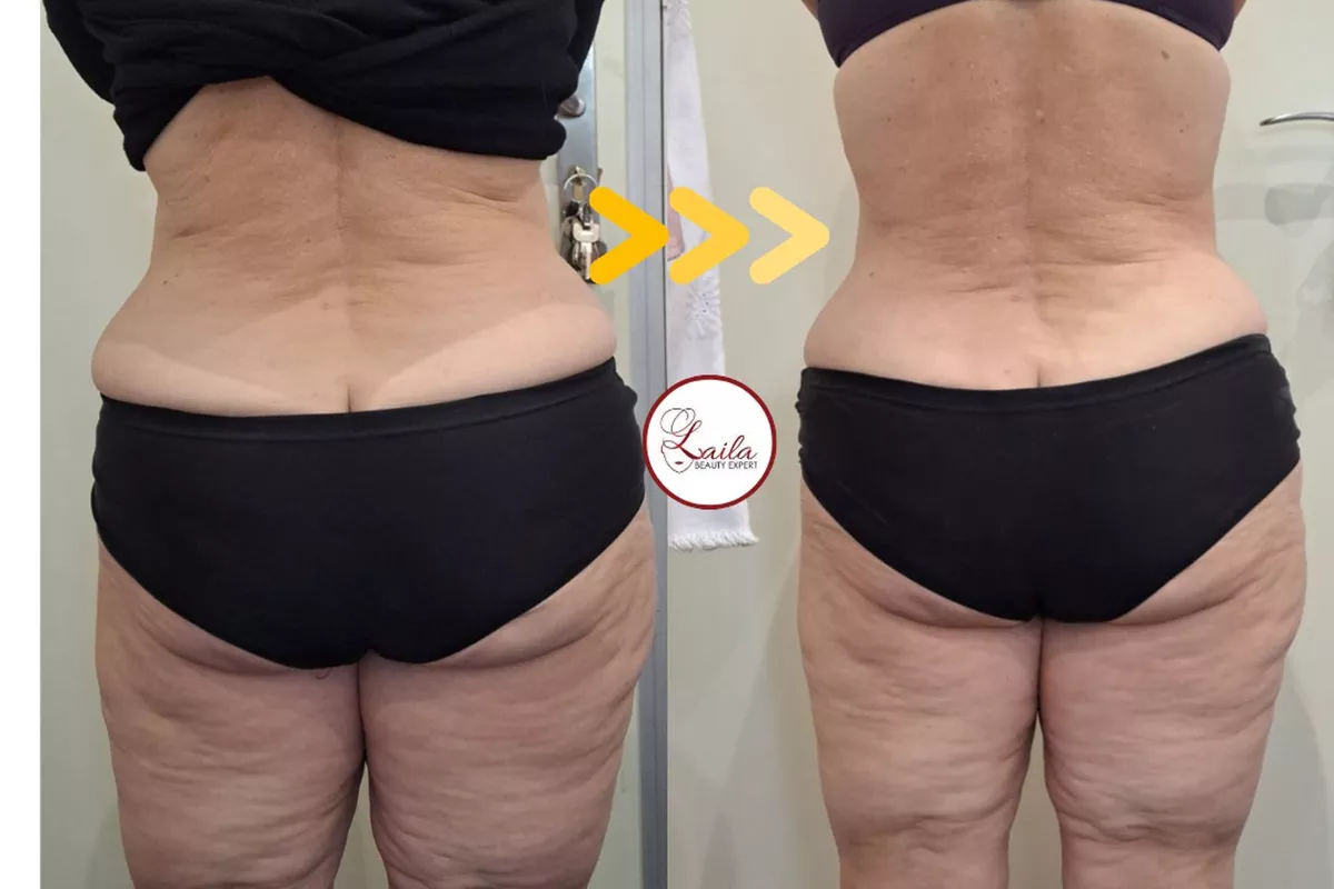 Formation professionnelle Peeling Bois-Guillaume